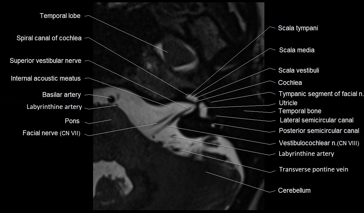 Internal auditory canal (IAC) axial cross sectional anatomy image 13.webp